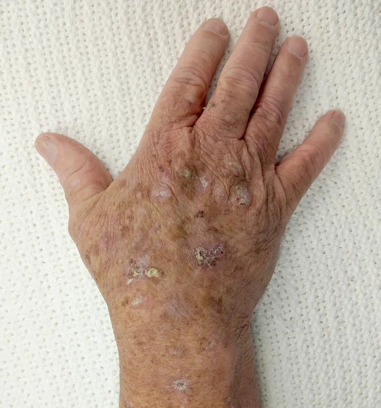 Handrücken mit aktinischen Keratosen