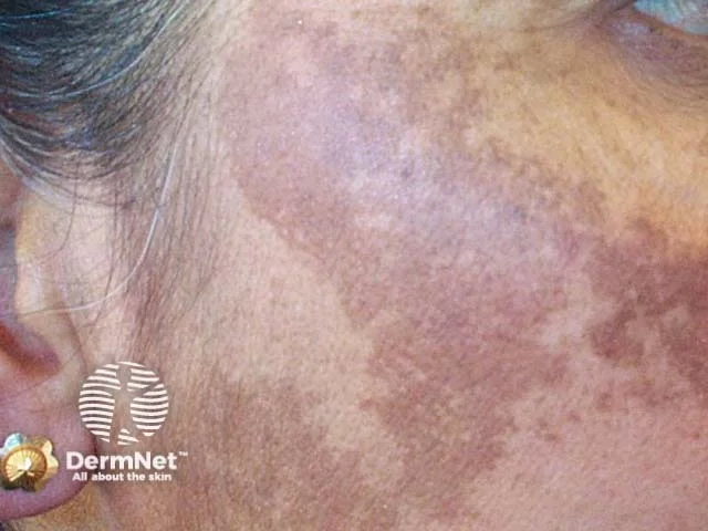 Melasma: brownish pigmented patches on the cheek
